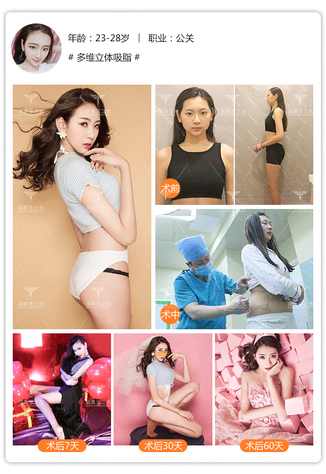 北京润美玉之光吸脂怎么样？价格案例分享
