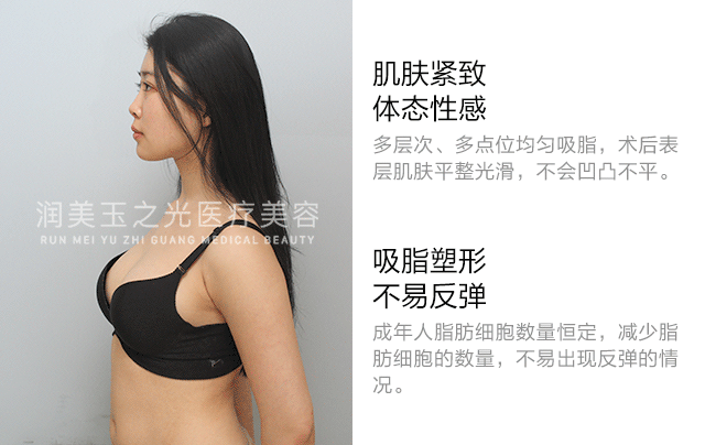 北京润美玉之光吸脂怎么样？价格案例分享
